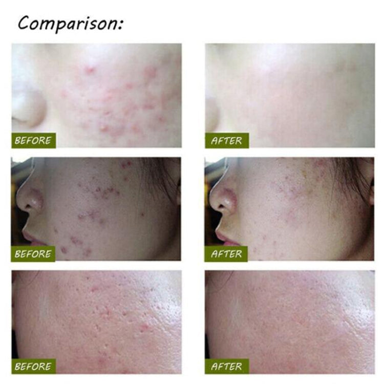 Acne treatment before-and-after skin comparison panels