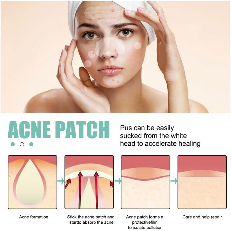 Breathable hydrocolloid acne patches on a woman’s forehead and cheeks with care diagram
