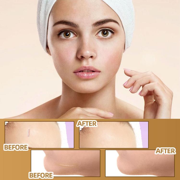 JAYSUING Waterproof Skin Scar Acne Mark Covering Patch, Acne Mark Covering Patch