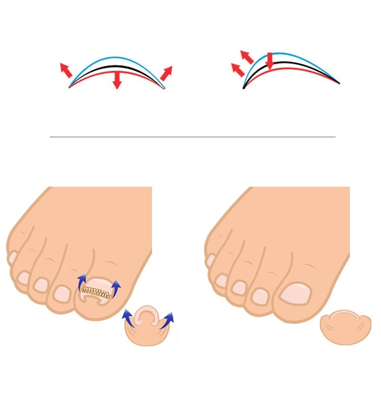 Diagram of toenail orthosis spring wrapping over the toenail for alignment