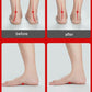 Orthopedic insole helps improve foot alignment, before and after with arch support