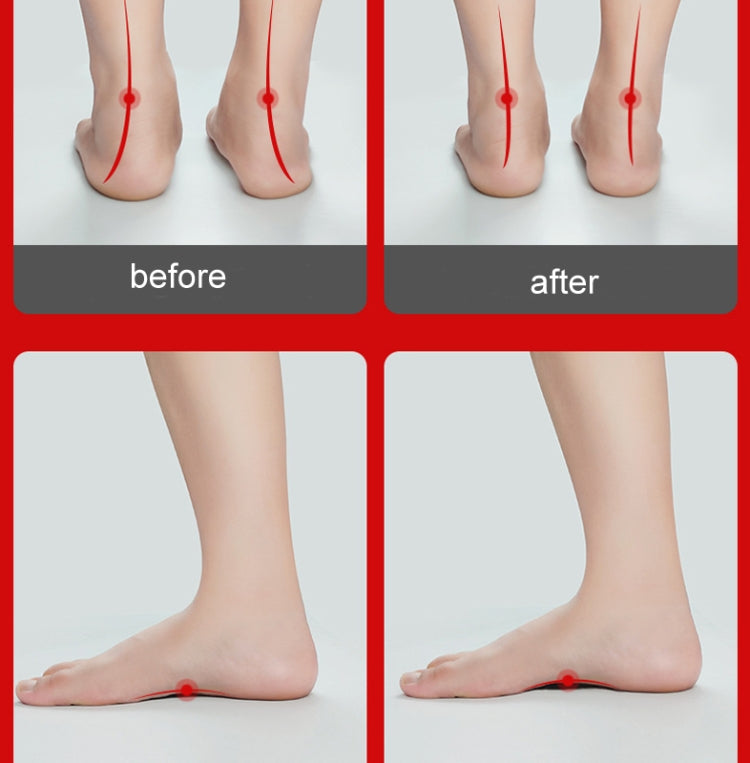 Orthopedic insole helps improve foot alignment, before and after with arch support
