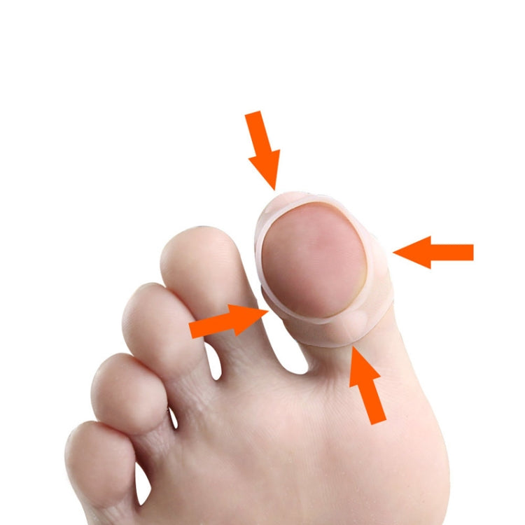Ingrown Nails Prevent Nails From Growing Flesh Nail Corrections, Free Size