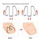 6pcs /Box Ortho Wire Nail Insertion Orthotic Toe Nail Ortho Hooks